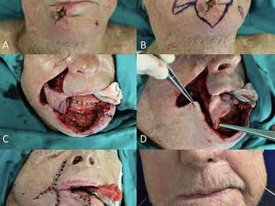 Locally advanced squamous cell carcinomas