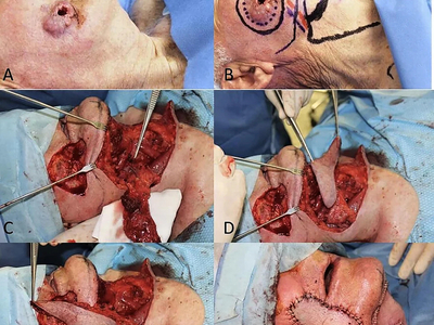 Locally advanced squamous cell carcinomas