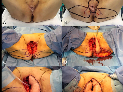 Locally advanced squamous cell carcinomas