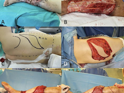 Locally advanced squamous cell carcinomas