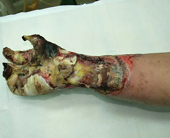 High Voltage electrical burns