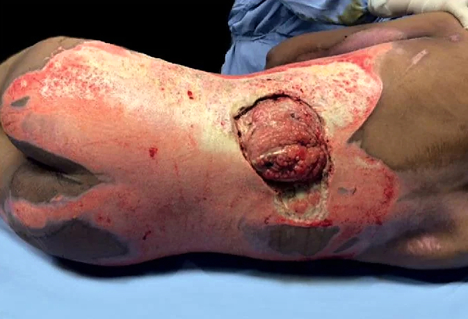 High Voltage electrical burns