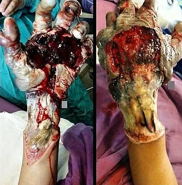 High Voltage electrical burns