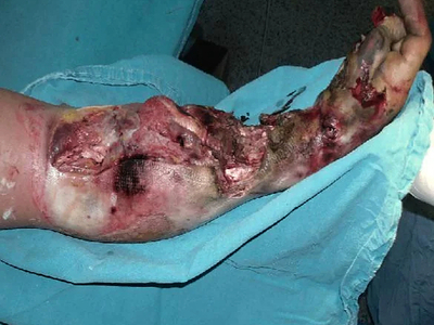 High Voltage electrical burns