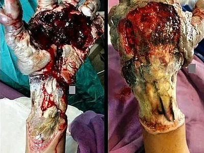 High Voltage electrical burns