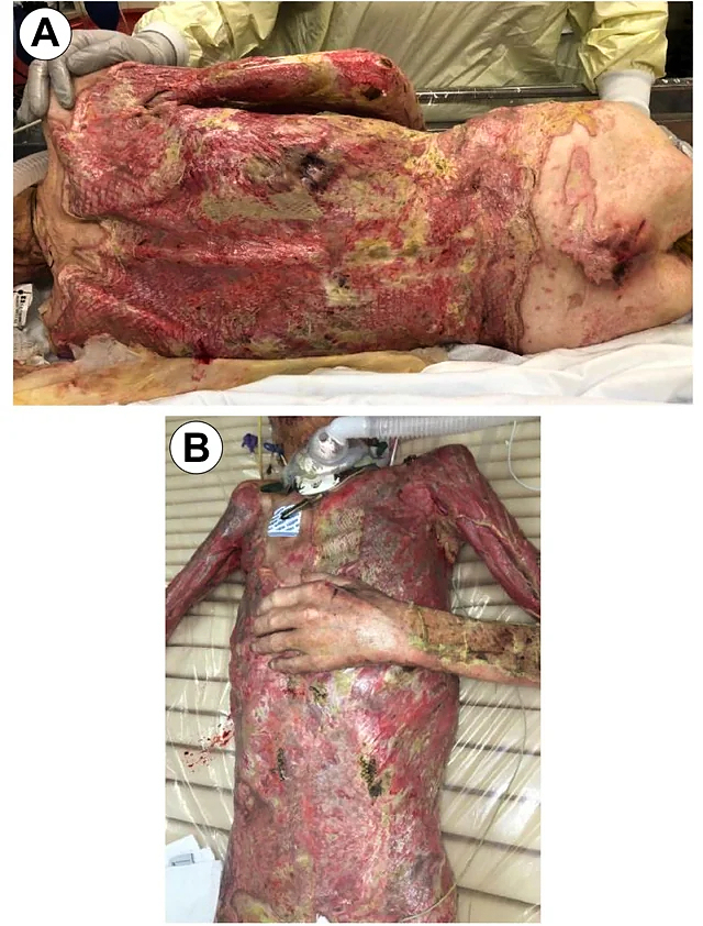 68-year-old male burned over 46% total body surface area