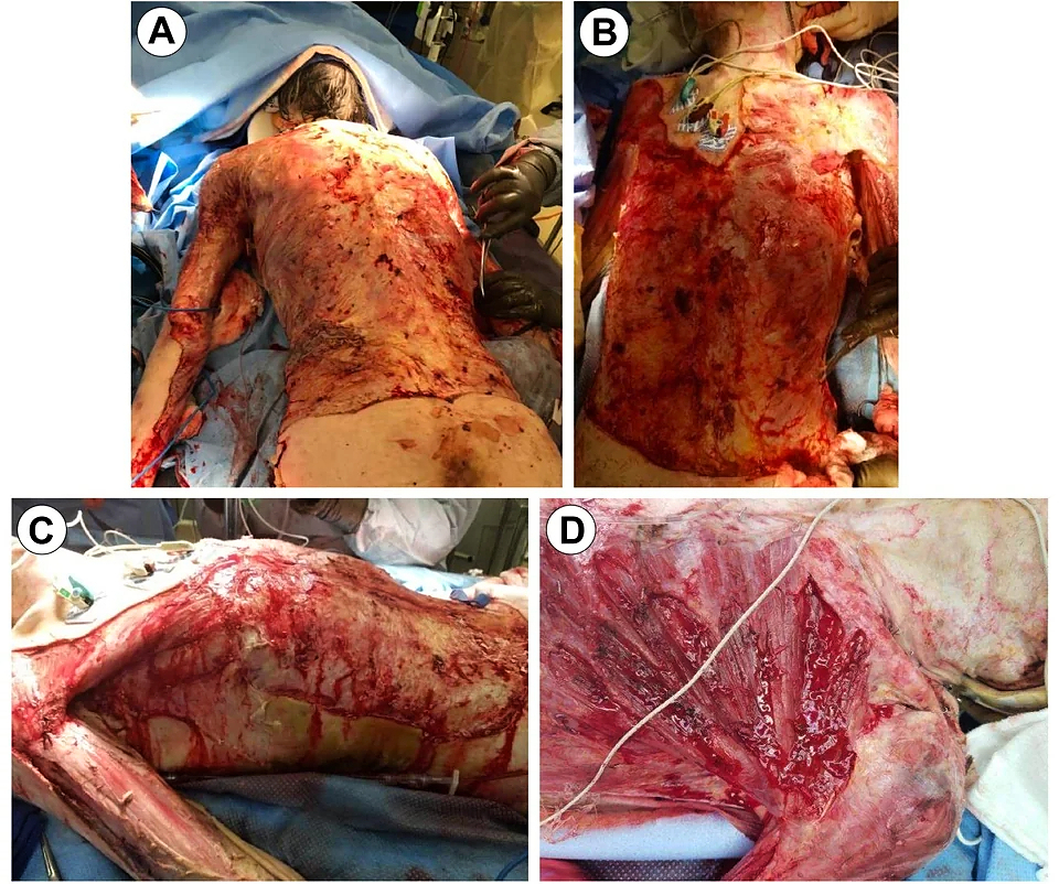 68-year-old male burned over 46% total body surface area