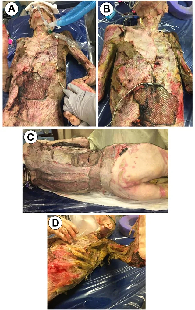 68-year-old male burned over 46% total body surface area