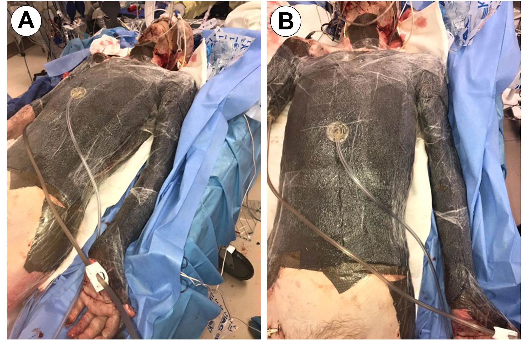 68-year-old male burned over 46% total body surface area