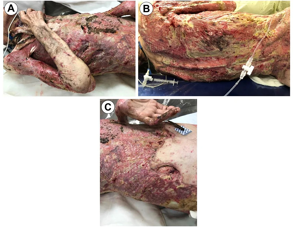 68-year-old male burned over 46% total body surface area
