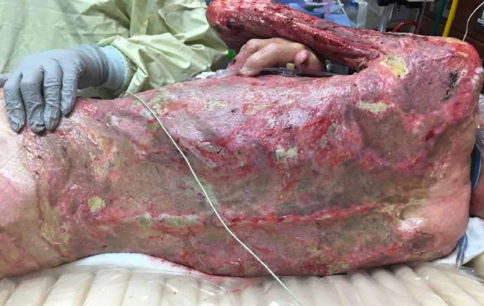 68-year-old male burned over 46% total body surface area