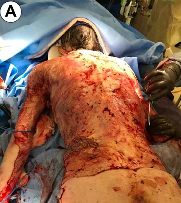68-year-old male burned over 46% total body surface area