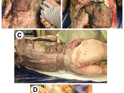 68-year-old male burned over 46% total body surface area