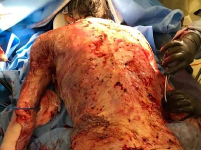 68-year-old male burned over 46% total body surface area