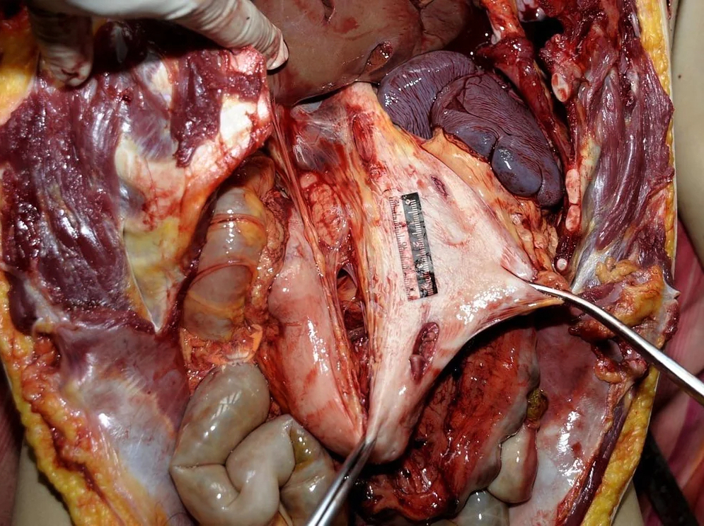 Woman stabbed to death with a partial autopsy at the scene