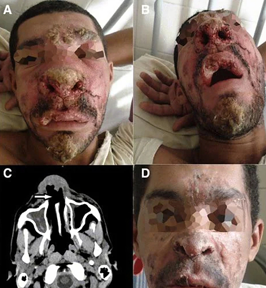 Mucocutaneous Leishmaniasis