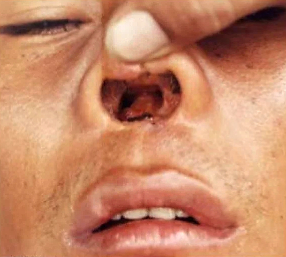 Mucocutaneous Leishmaniasis