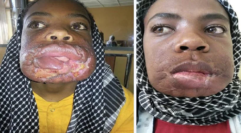 Mucocutaneous Leishmaniasis