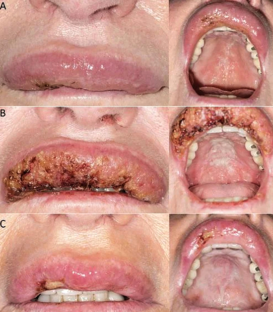 Mucocutaneous Leishmaniasis