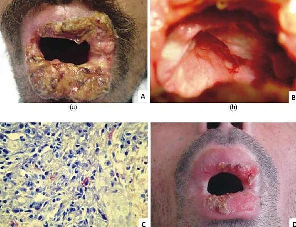 Mucocutaneous Leishmaniasis