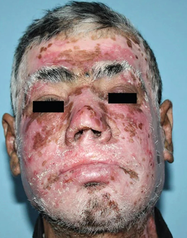 Mucocutaneous Leishmaniasis