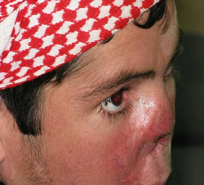 Mucocutaneous Leishmaniasis