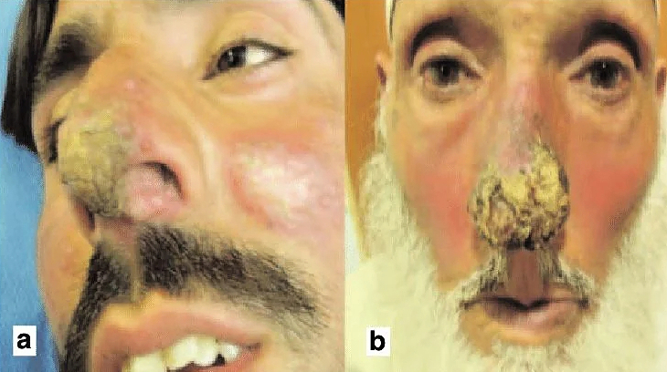 Mucocutaneous Leishmaniasis