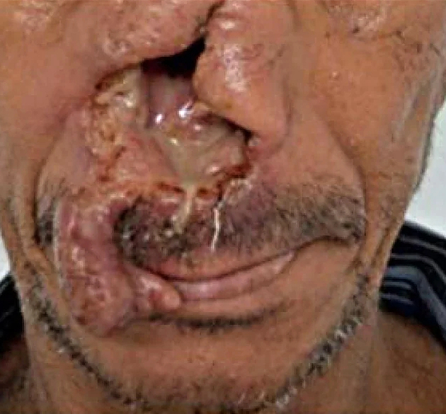 Mucocutaneous Leishmaniasis