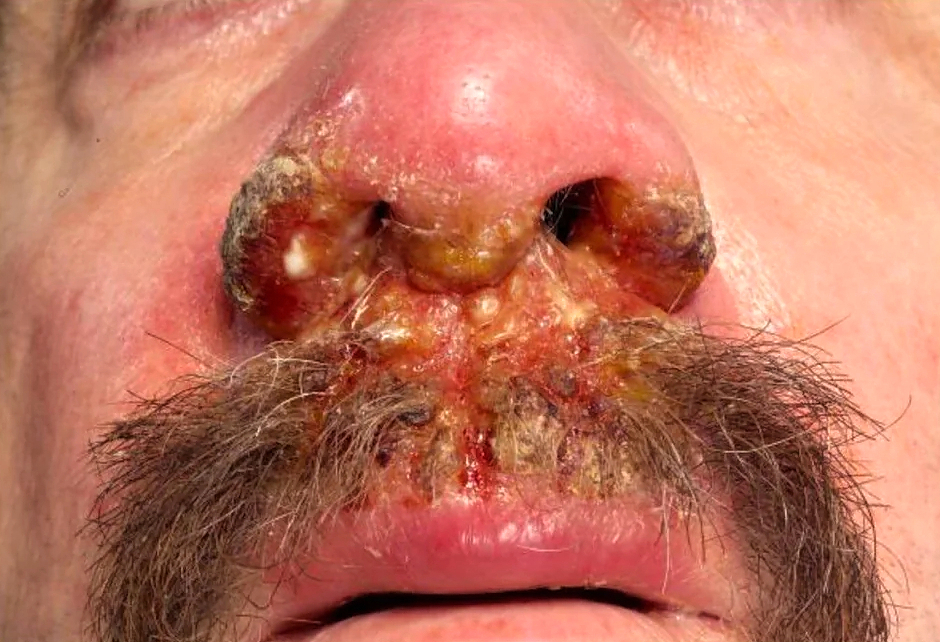 Mucocutaneous Leishmaniasis