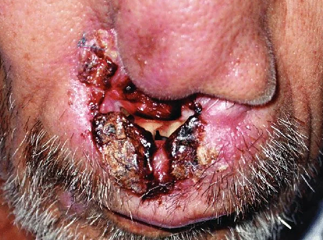 Mucocutaneous Leishmaniasis