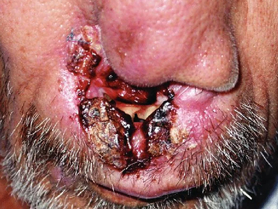 Mucocutaneous Leishmaniasis