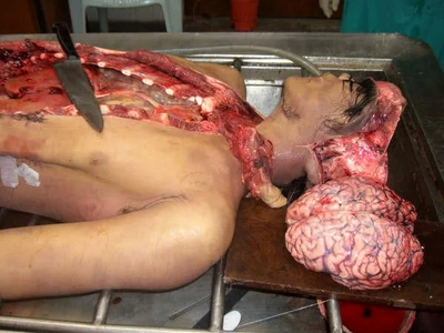 A collection of autopsies of various men