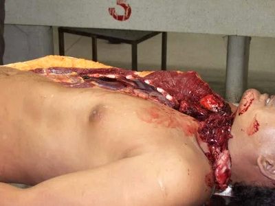 A collection of autopsies of various men