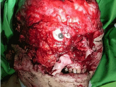 Severe facial trauma of varying degrees