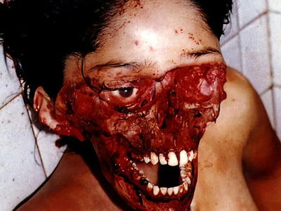 Severe facial trauma of varying degrees