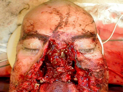 Severe facial trauma of varying degrees