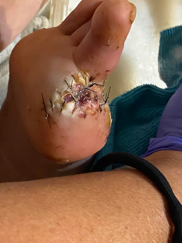 Trailer fell onto foot