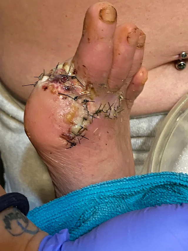 Trailer fell onto foot