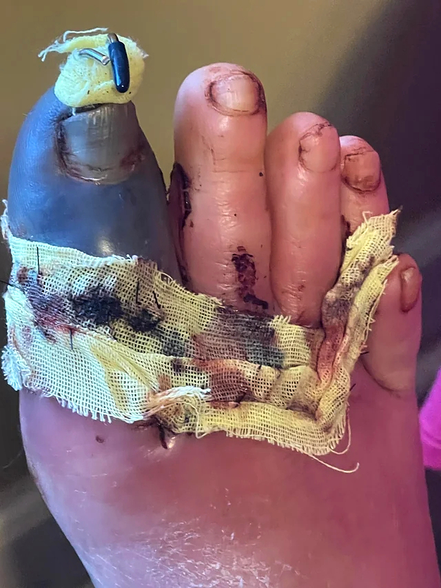 Trailer fell onto foot