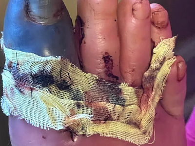 Trailer fell onto foot