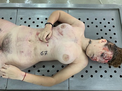 Young woman with cracked skull