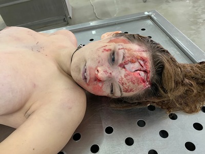 Young woman with cracked skull