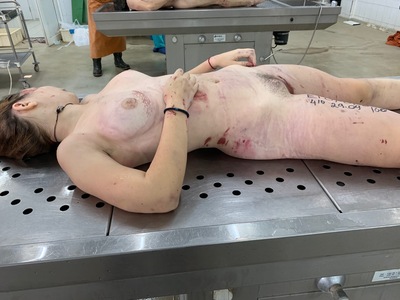 Dead young woman with cracked skull.