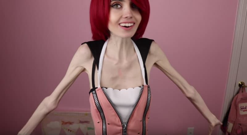 Eugenia Cooney anorexic