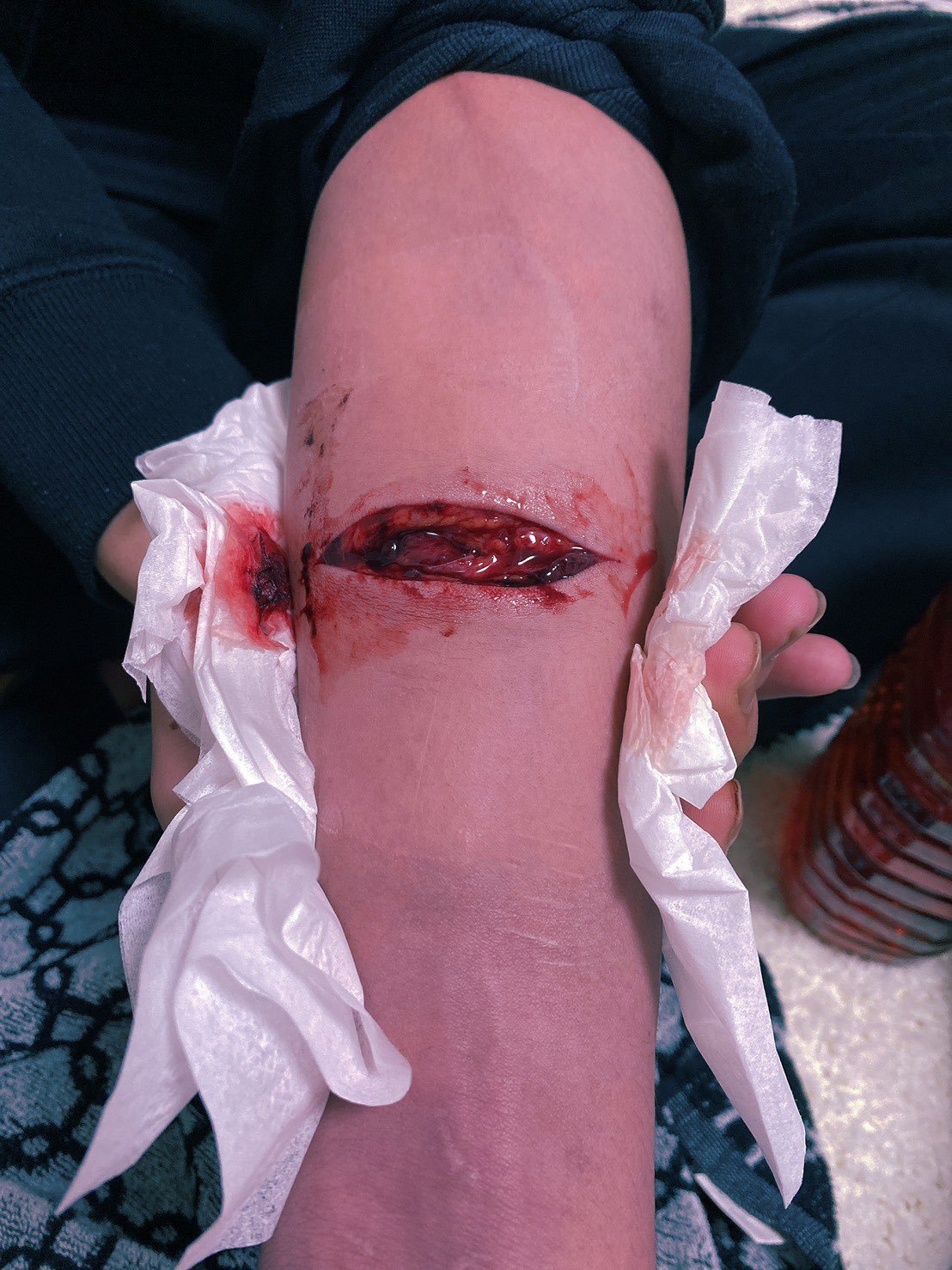 Depressed teenager bloody self harm