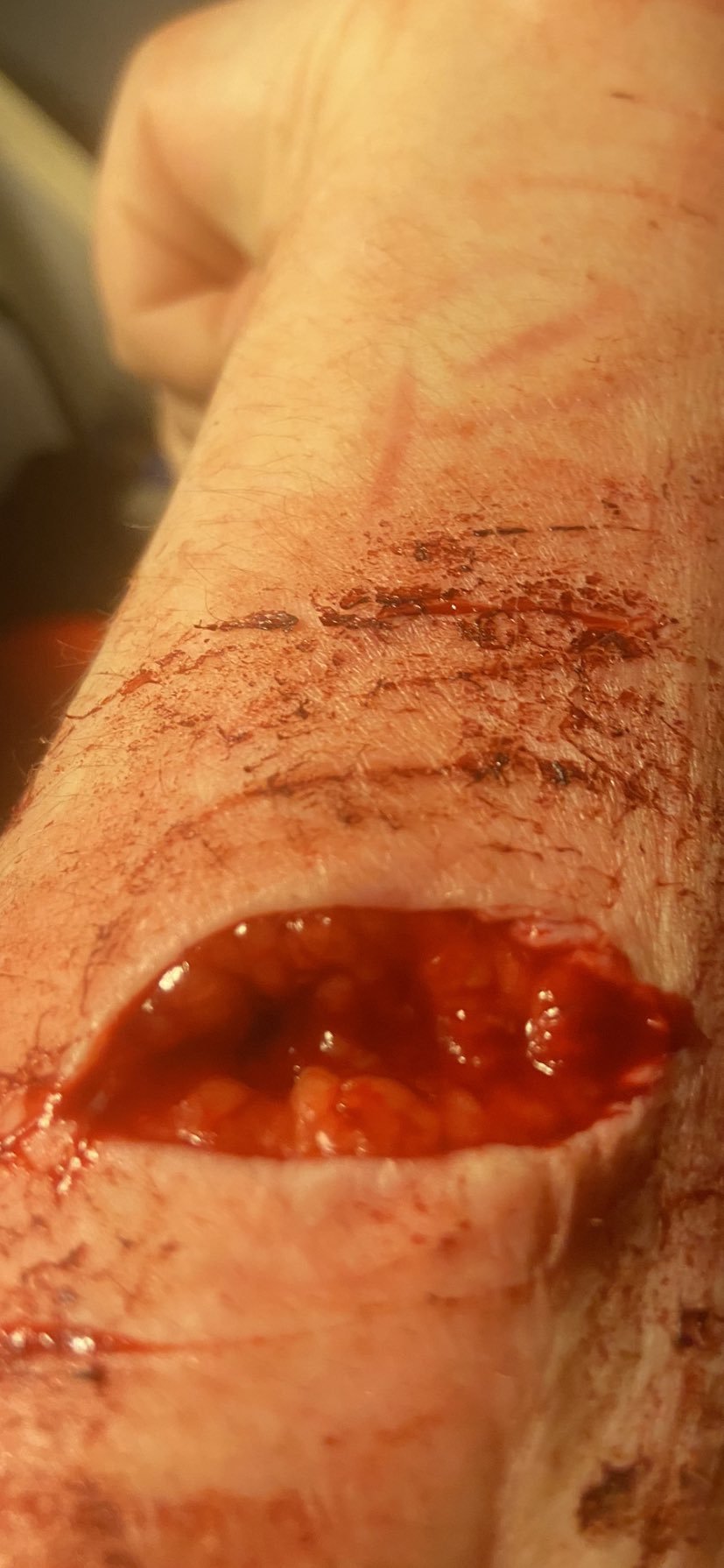 Depressed teenager bloody self harm