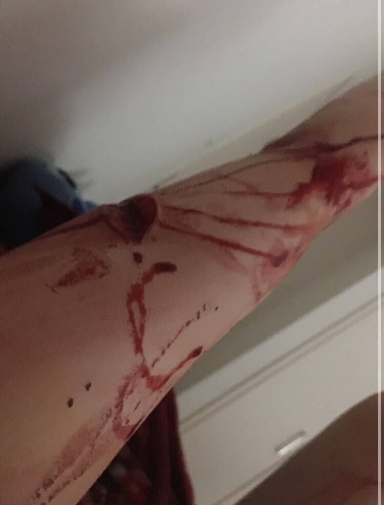 Depressed teenager bloody self harm