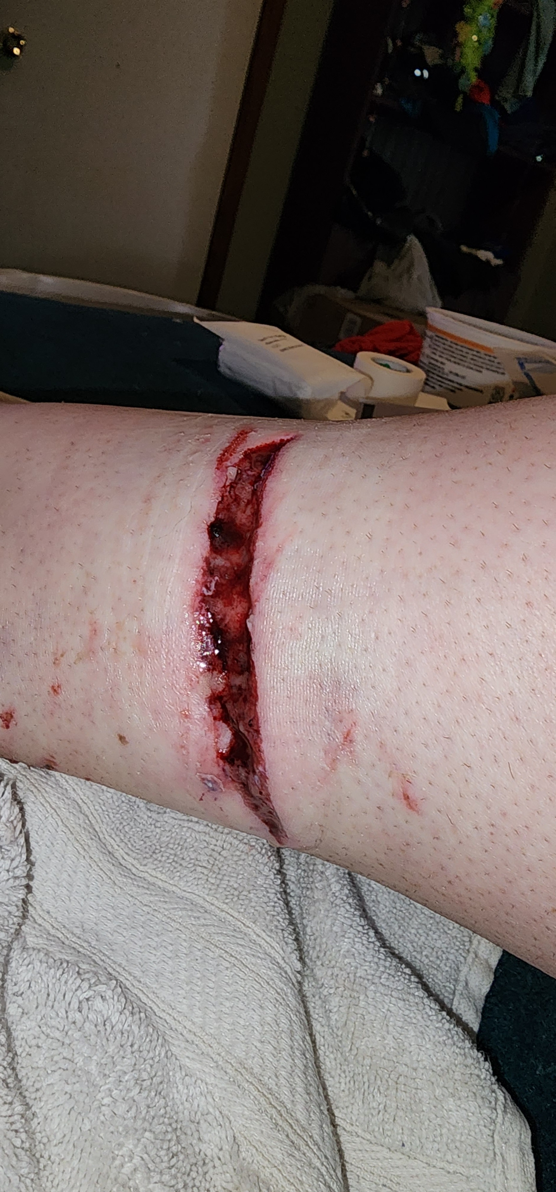 Dog bite wound