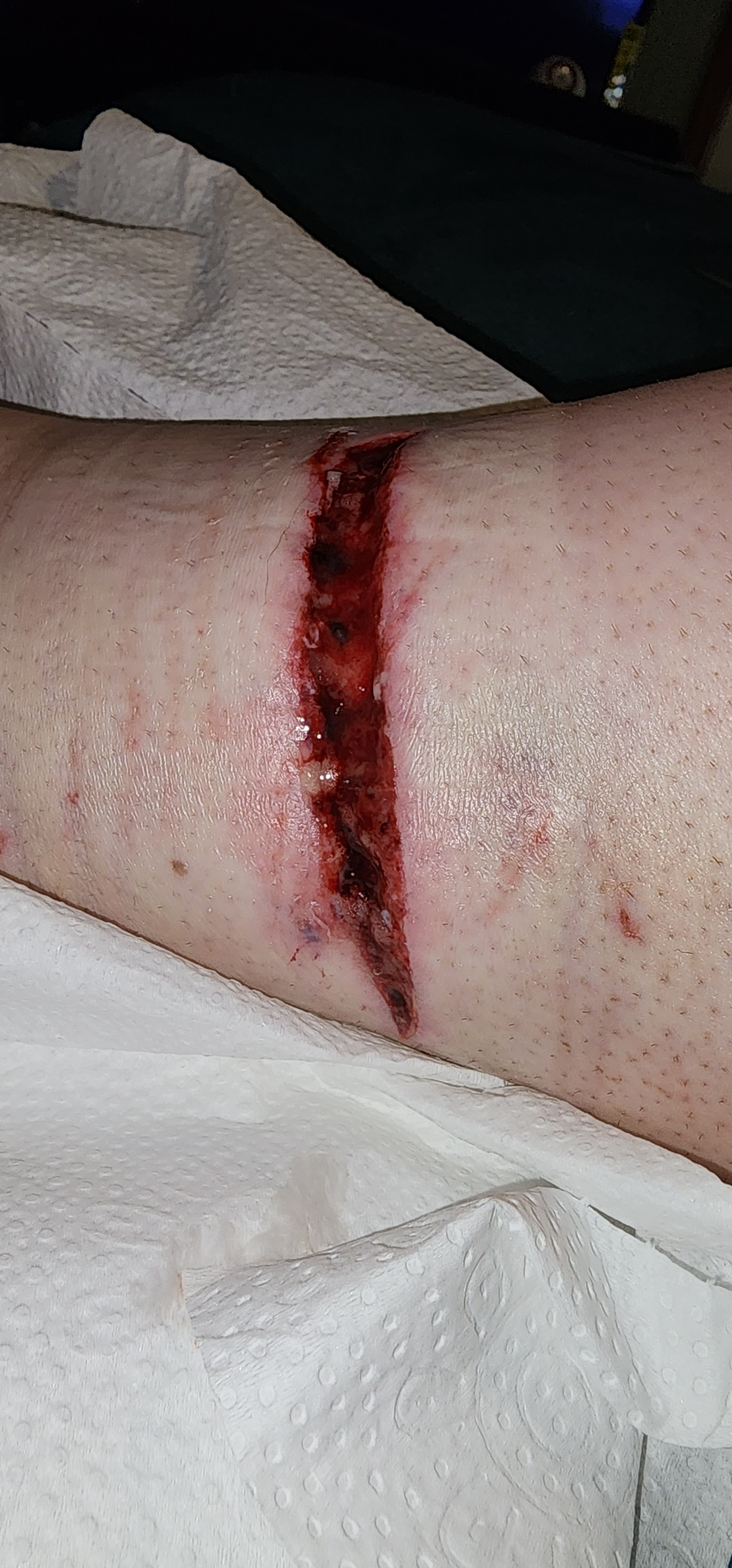 Dog bite wound