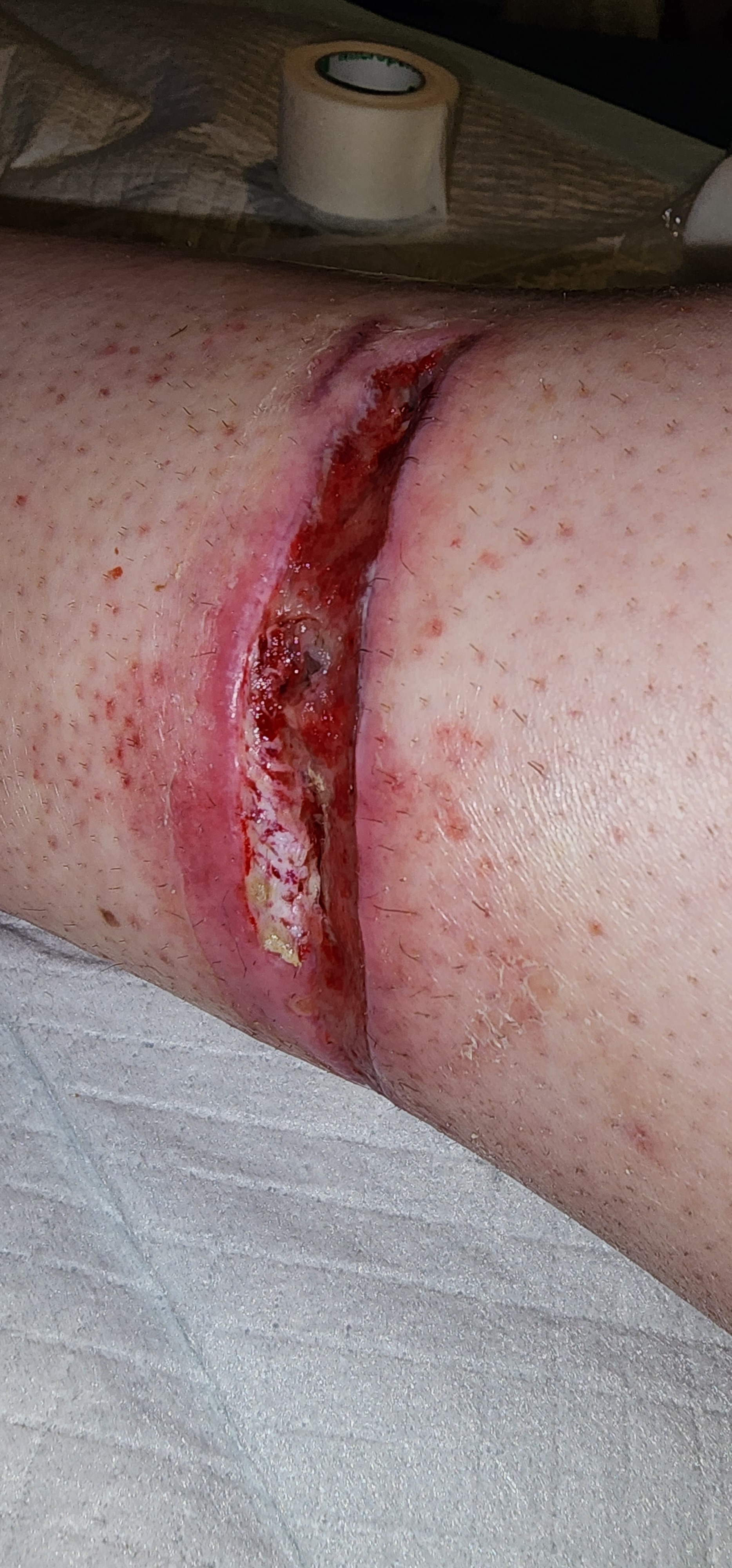 Dog bite wound